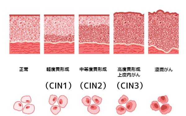 重度異形成の原因は何ですか?