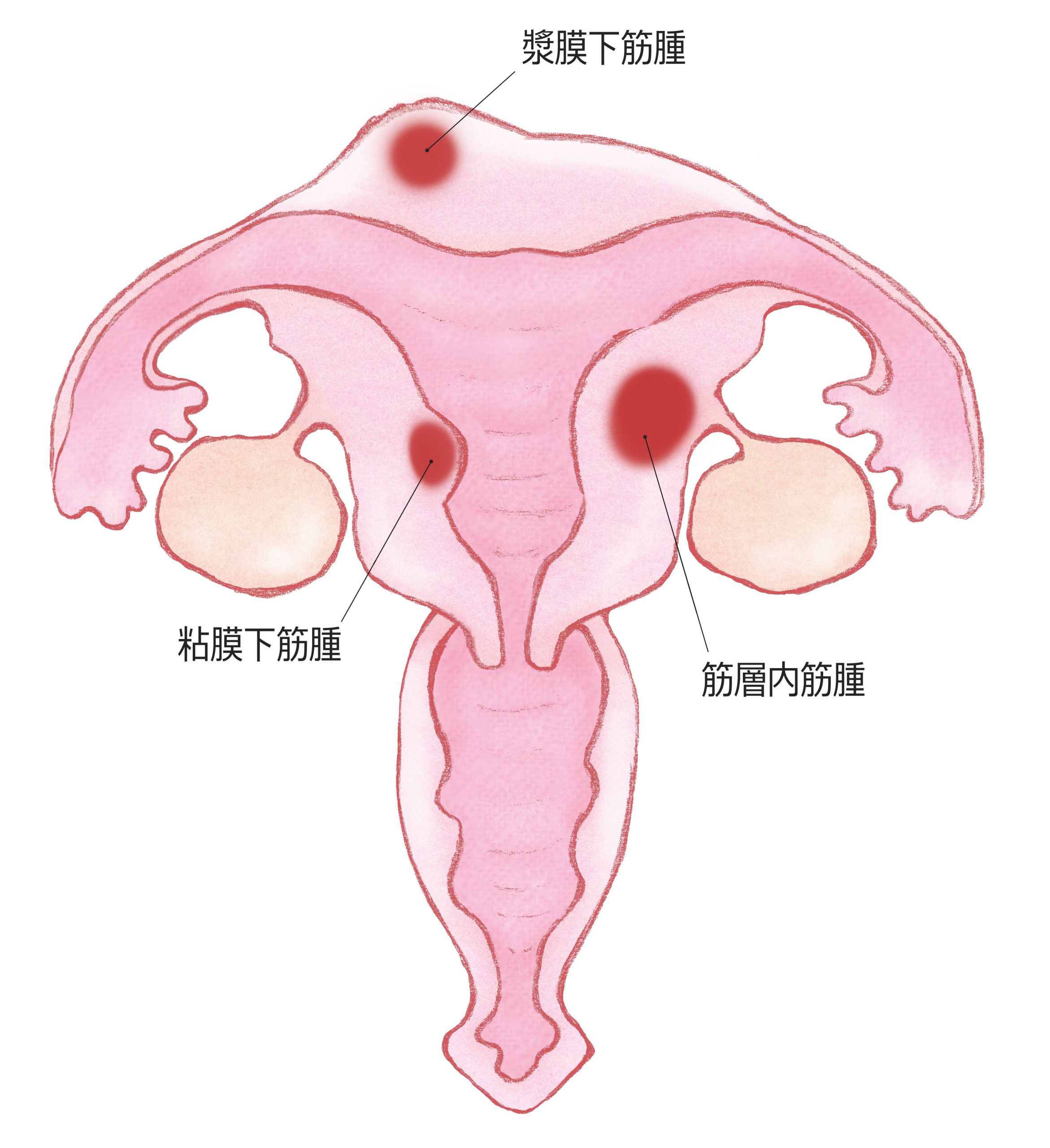 子宮筋腫の分類別症状イメージ